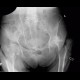 Osteonecrosis of femoral head, osteoarthrosis: X-ray - Plain radiograph